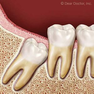 Wisdom tooth